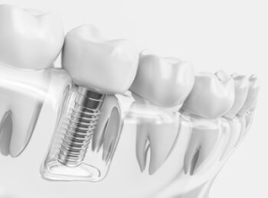 dental implant surgery Campbelltown