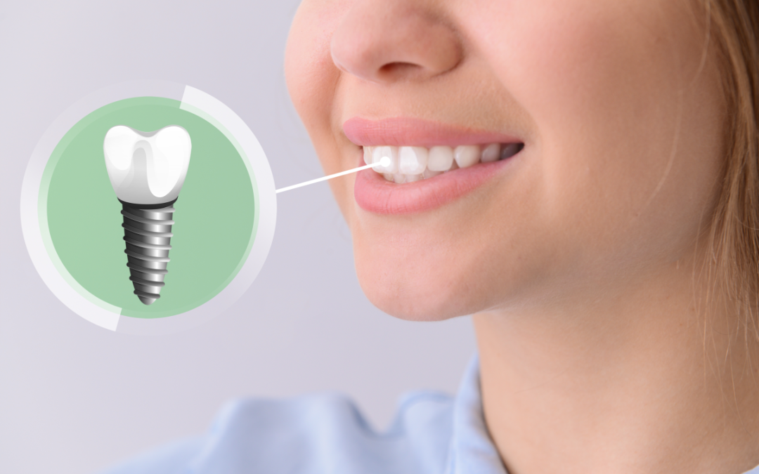 Dental Implants Cost Per Tooth – A Detailed Guide
