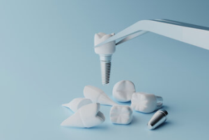 dental implant surgery campbelltown