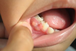kids tooth decay abscess