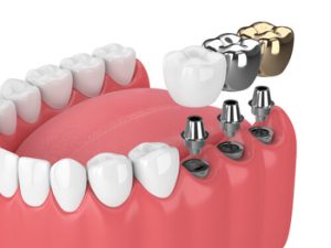 Dental Implants Vs Bridge types campbelltown