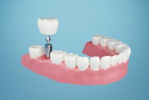 Affordable Dental Implants illustration campbelltown