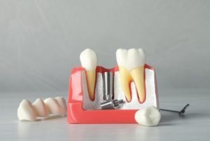 Affordable Dental Implants image campbelltown