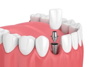 Dental Implants Bangkok procedure campbelltown