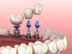 Cost-Of-Single-Tooth-Implants-placement-campbelltown