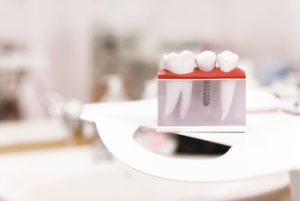 Dental Insurance That Covers dental Implants campbelltown