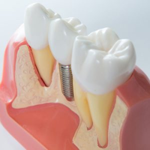 dental-implants-turkey-appearance-campbelltown