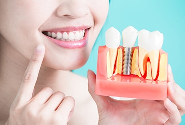 dental implant services