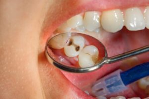 How Long Does a Tooth Filling Last decay