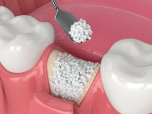 what is a bone graft procedure