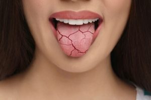 Dry Mouth Symptoms lacks saliva