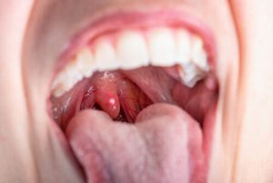 Dry Mouth Symptoms throat