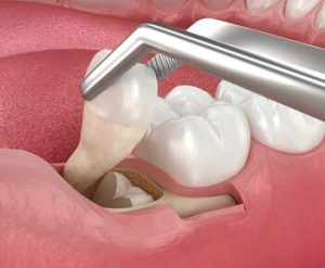 Removing Root Canal Tooth procedure