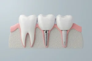 how to relieve pain from dental implant procedure