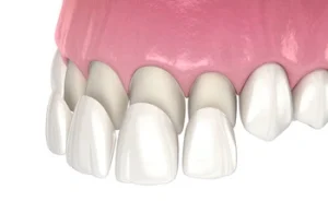 porcelain veneers cost application