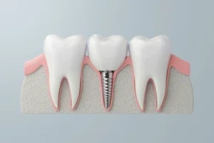 Dental Implant Healing Stages expectation