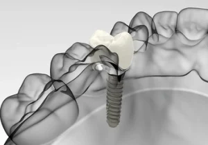 Tooth Implant vs. Bridge results